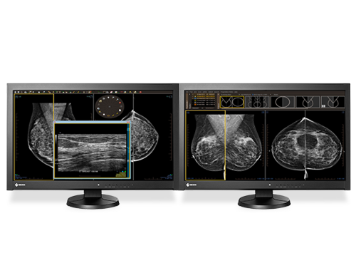 breast imaging on two computer monitors